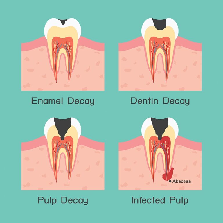 how-to-treat-exposed-tooth-root