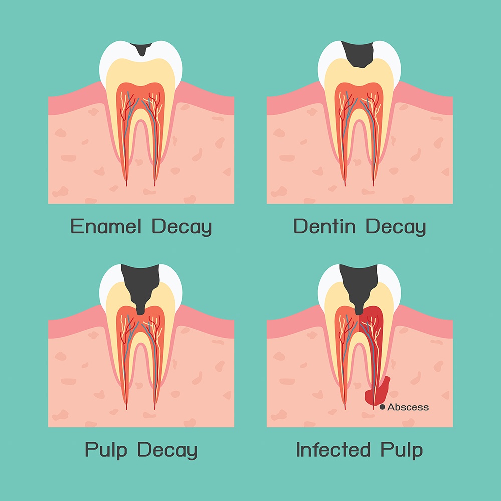 How to treat exposed tooth root?