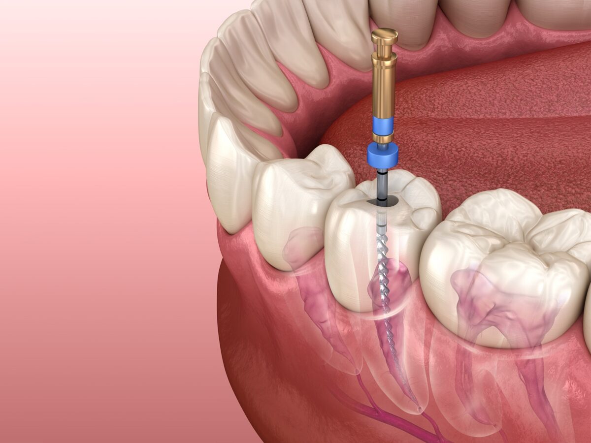 Can Amoxicillin Treat Root Canal Infection 