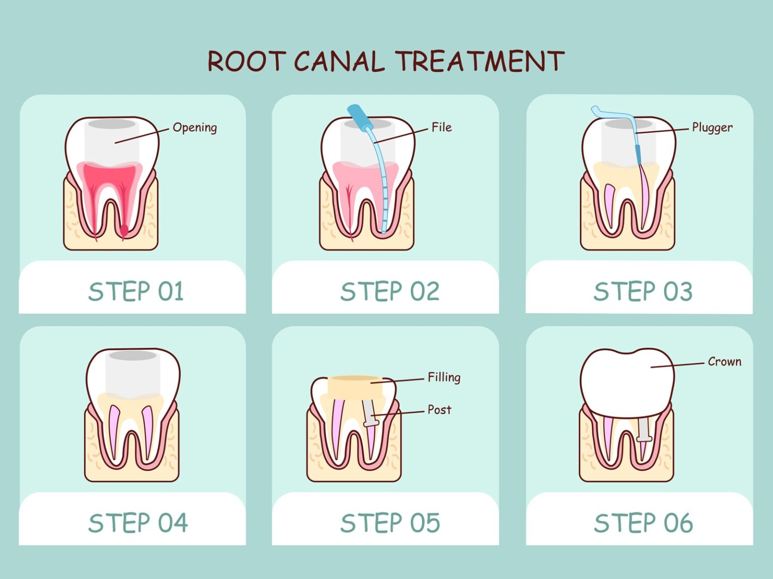 how-long-is-root-canal-recovery