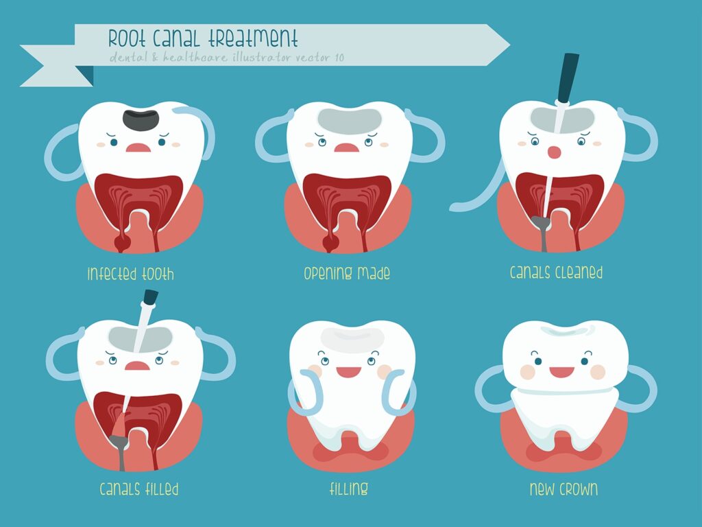 can-you-get-a-filling-instead-of-a-root-canal