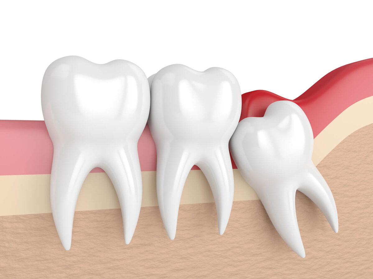 Wisdom Tooth Extraction