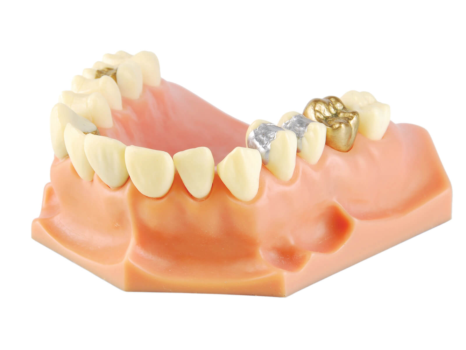 5 Reasons To Replace Your Silver Fillings