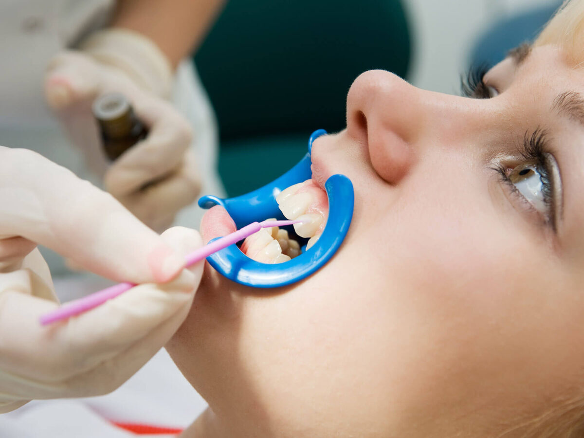 How Can Dental Sealants Prevent Cavities?