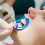 How Can Dental Sealants Prevent Cavities?