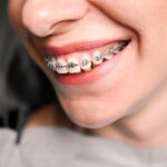 How To Speed Up Your Braces Process