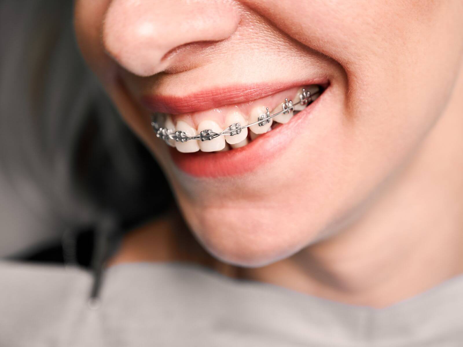 How To Speed Up Your Braces Process