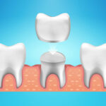 Understanding The Roles And Benefits of Dental Crowns For Stronger Teeth