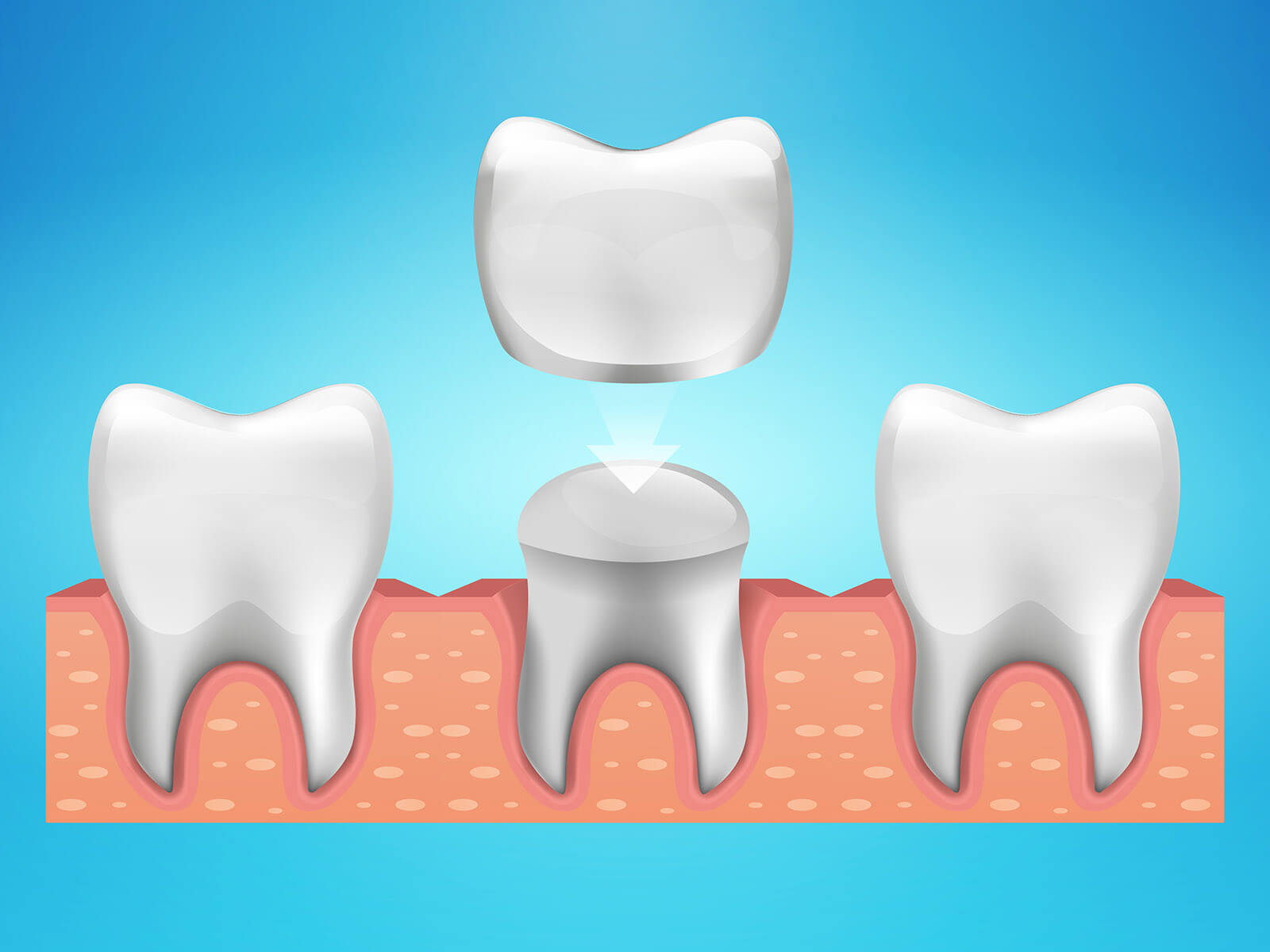 Understanding The Roles And Benefits of Dental Crowns For Stronger Teeth