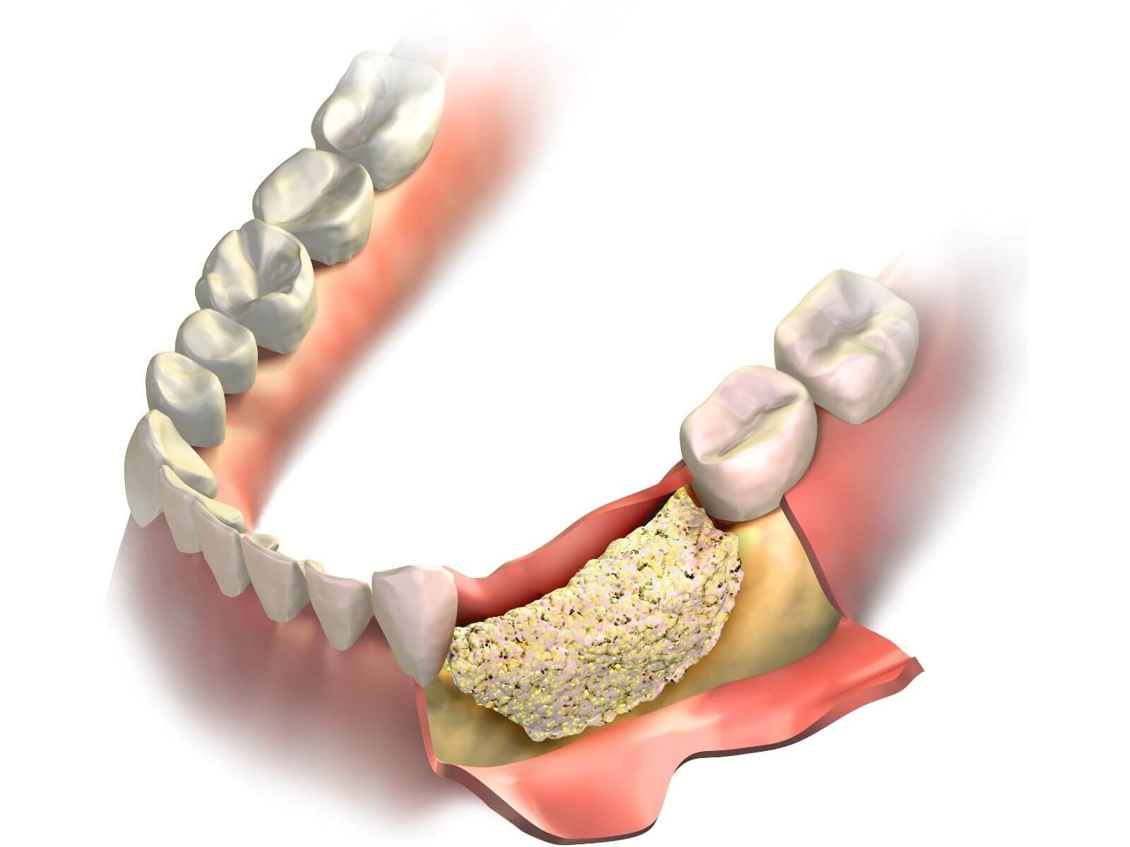 Can You Restore Bone Loss In Your Teeth?