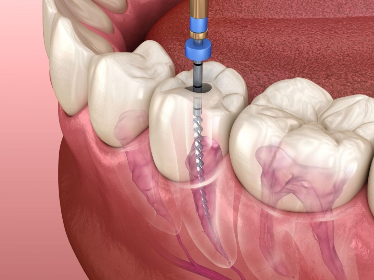 5 Proven Ways To Prevent A Root Canal