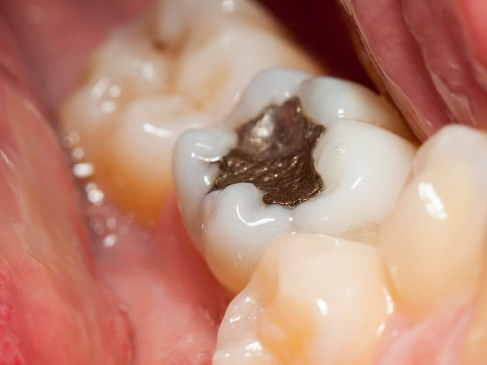 5 Signs You Need A Dental Filling