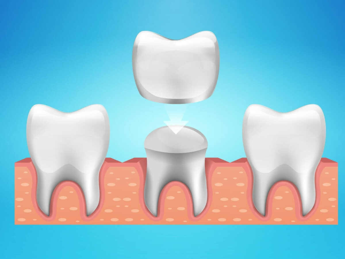 Exploring Dental Crown Complications And Prevention Tips