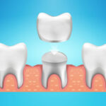 Exploring Dental Crown Complications And Prevention Tips